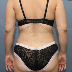 Bra & Back Fat Treatment Surrey