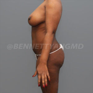 Starting $254 /mo Brazilian Butt Lift Payment Plan