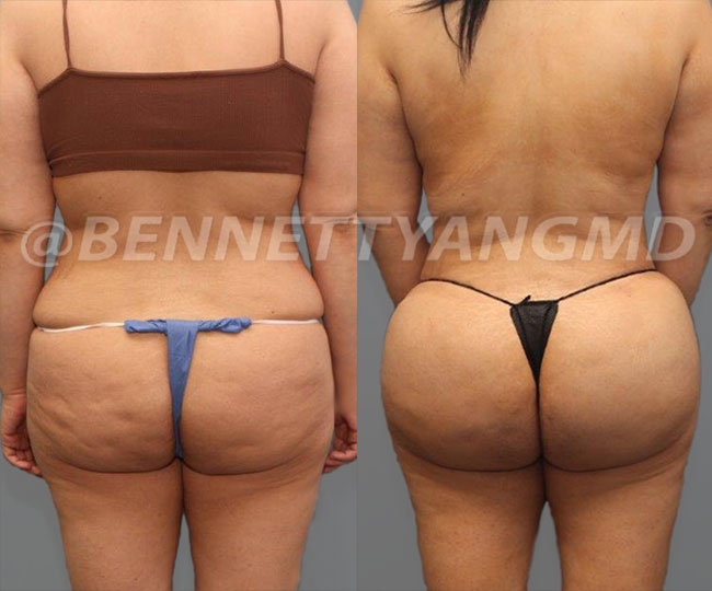 Brazilian Butt Lift (BBL): Before & After Photos Atlanta