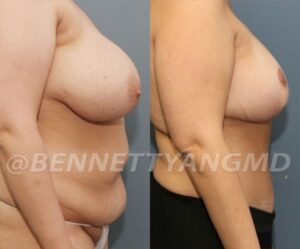 BBL Maryland Plastic Surgeon Bennett C. Yang
