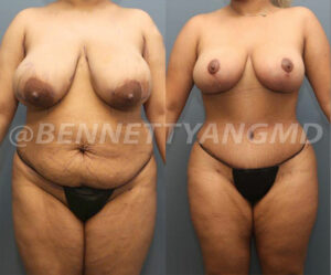 Bennett Yang, MD Lipo360 Surgeon Maryland, Lipo 360 Surgeon Maryland, DMV Lipo360, DMV Lipo 360