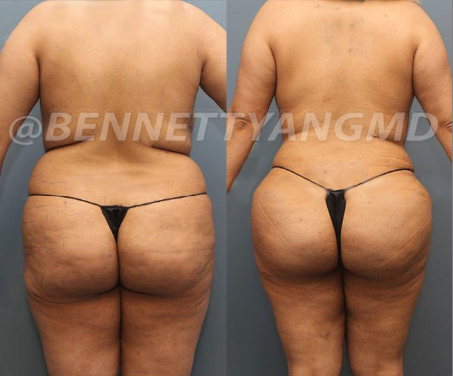 Starting $254 /mo Brazilian Butt Lift Payment Plan