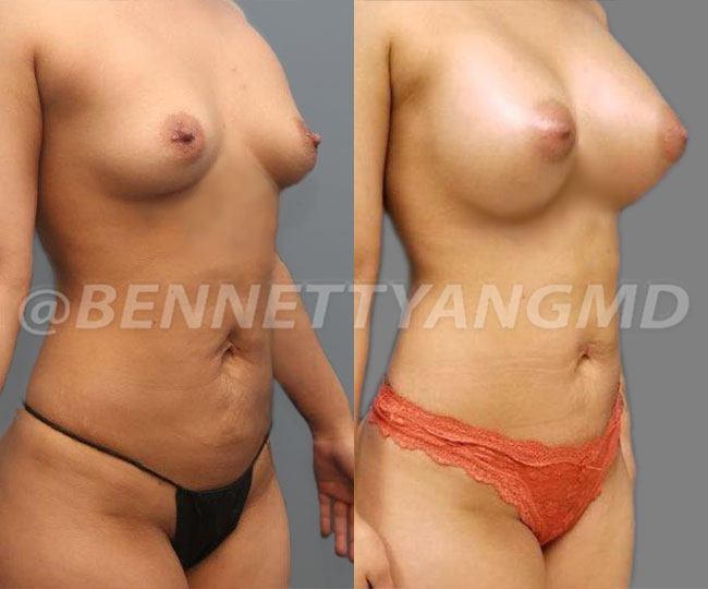 BBL Maryland Plastic Surgeon Bennett C. Yang