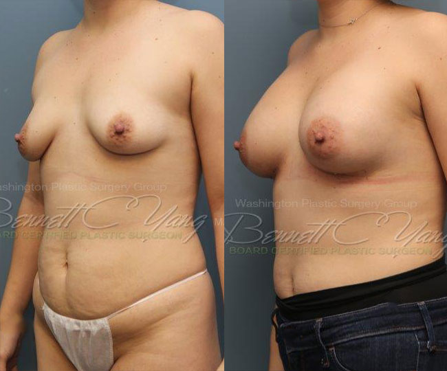 Pat13-breast_before_after_3d1