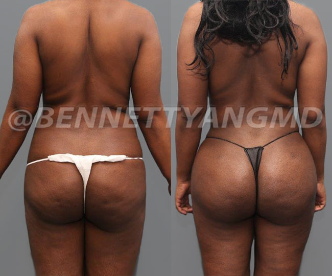 BBL Before And After Images - Brazilian Butt Lift Maryland