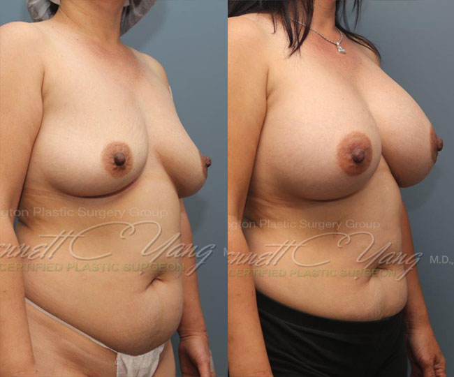 breastaugmentation.after.subfascial.bennettyangmd.wm.front_before_after2