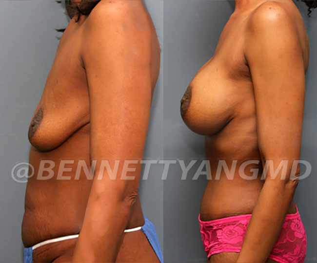 full-tummy-tuck-patient-before-after-17a