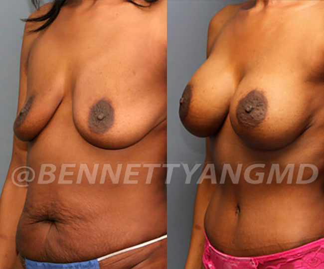 full-tummy-tuck-patient-before-after-17b