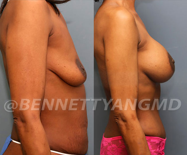 BBL Maryland Plastic Surgeon Bennett C. Yang