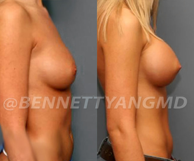 BBL Maryland Plastic Surgeon Bennett C. Yang