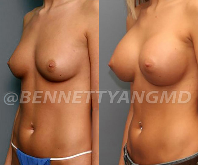 BBL Maryland Plastic Surgeon Bennett C. Yang