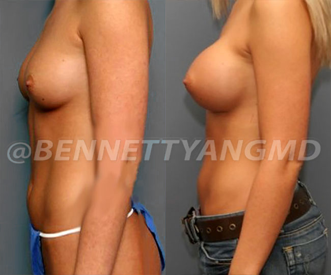 BBL Maryland Plastic Surgeon Bennett C. Yang