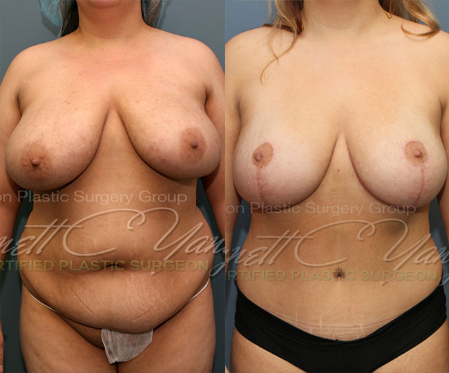 20121116_0559.breastreduction.tummytuck.mommymakeover.wm_before_after