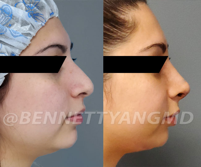 BBL Maryland Plastic Surgeon Bennett C. Yang