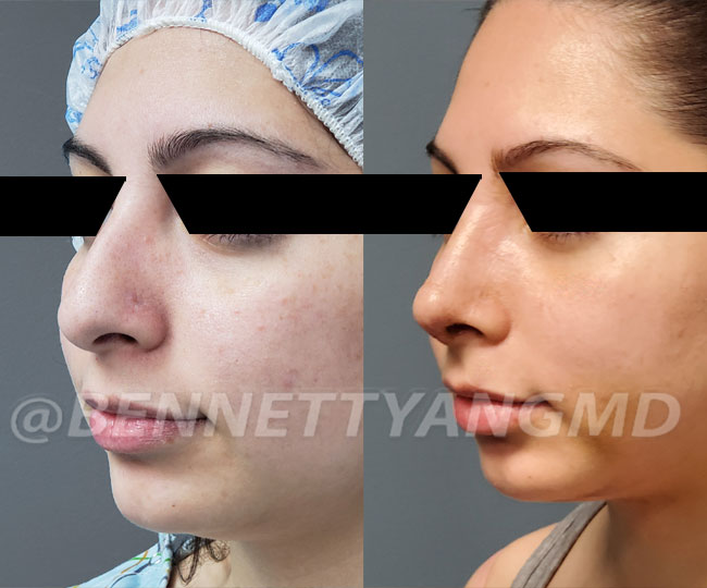 Ethnic Rhinoplasty Maryland - Before and After Images