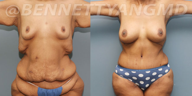 Weight Loss Surgery - Before and After