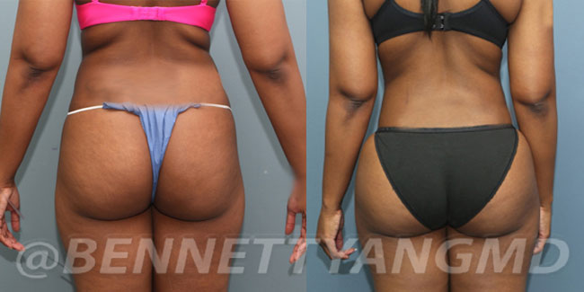Brazilian Butt Lift – BBL Before & After Pictures.