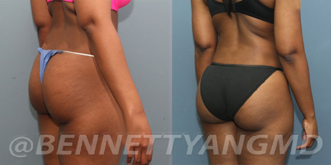 DMV BBL Plastic Surgeon, Brazilian Butt Lift Top Surgeon Maryland