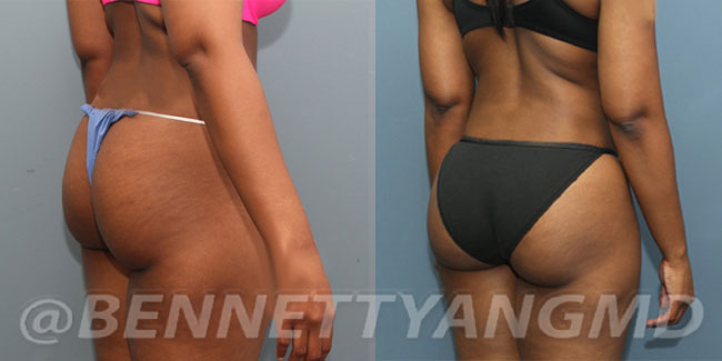 DMV BBL Plastic Surgeon, Brazilian Butt Lift Top Surgeon Maryland