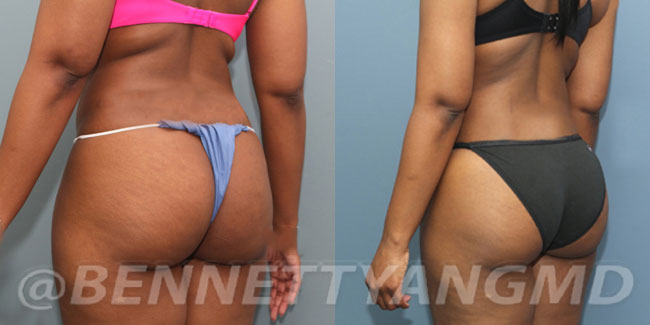 Brazilian Butt Lift Before & After Pictures.