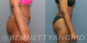Brazilian Butt Lift – BBL Before & After Pictures.