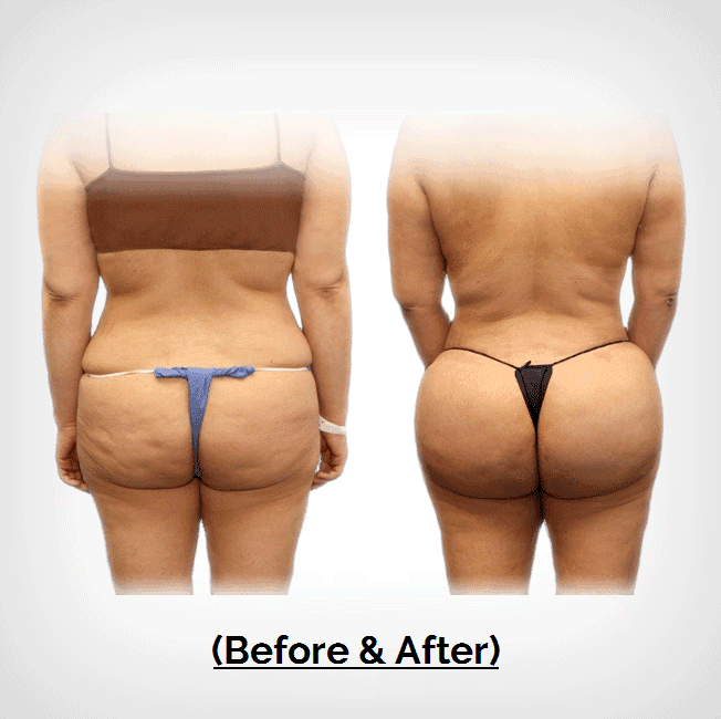 Brazilian Butt Lift Plastic Surgery Payment Plans