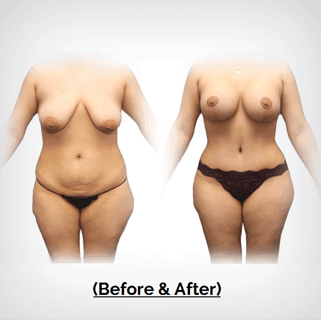 Breast Lift Tummy Tuck Plastic Surgery Payment Plans