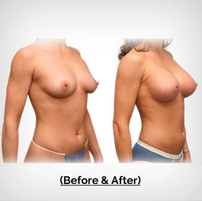 Patient Before After Breast Augmentation Plastic Surgery Payment Plans