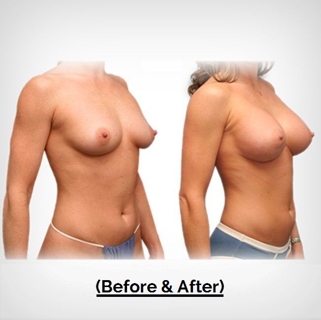 Amazing Breast Augmentation Patient2 Before After Images Bennett C Yang, MD