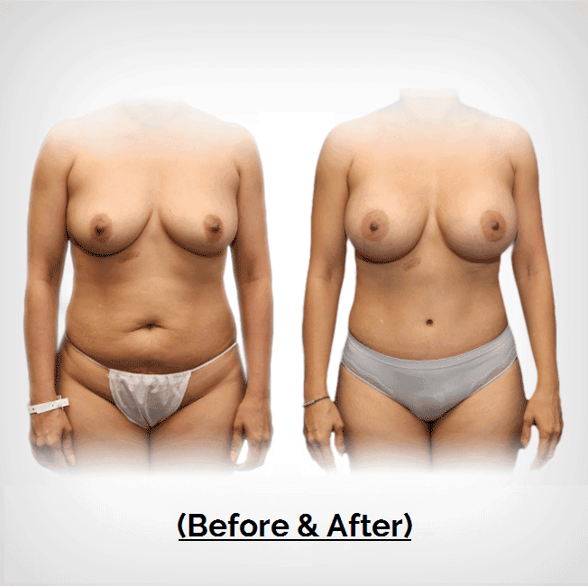 Mommy Makeover Tummy Tuck Liposuction Plastic Surgery Payment Plans