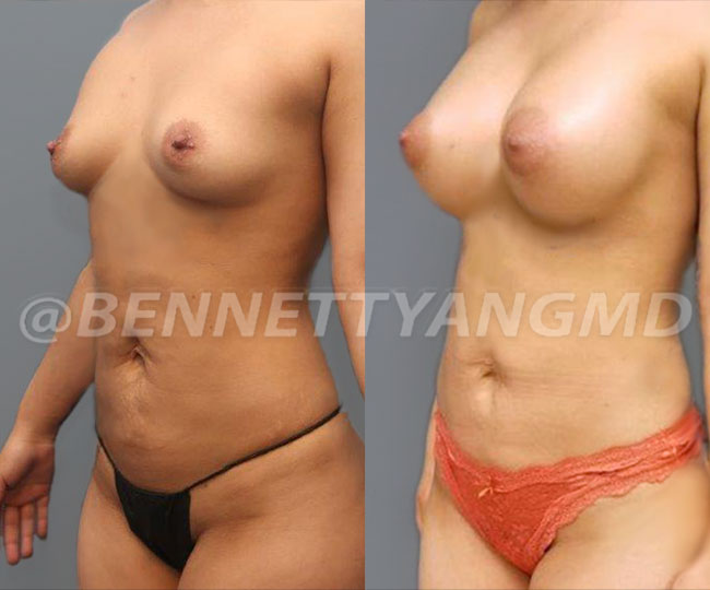 BBL Maryland Plastic Surgeon Bennett C. Yang