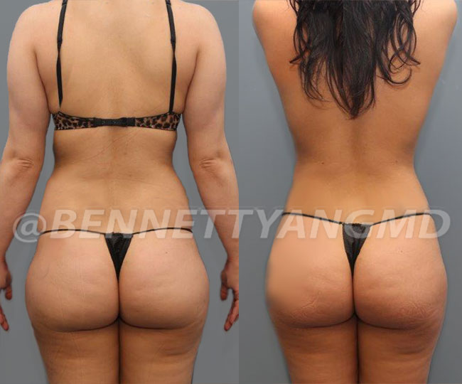 Starting $254/mo Brazilian Butt Lift Payment Plan