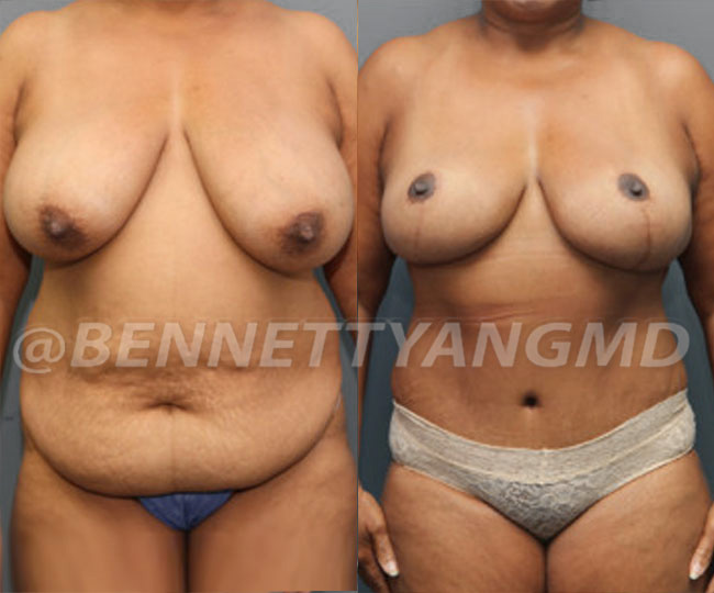 Breast Lift Patient Before & After Images - Maryland Breast Surgeon