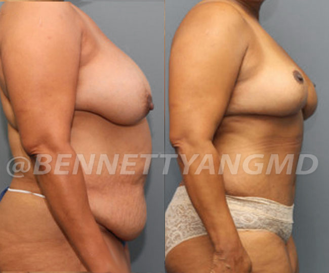 Breast Lift Patient Before & After Images - Maryland Breast Surgeon