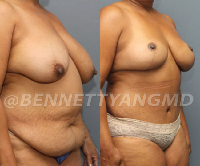 Breast Lift Patient Before & After Images - Maryland Breast Surgeon