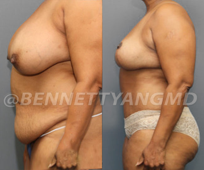 Breast Lift Patient Before & After Images - Maryland Breast Surgeon