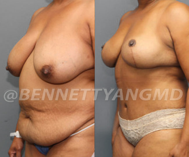 Breast Lift Patient Before & After Images - Maryland Breast Surgeon