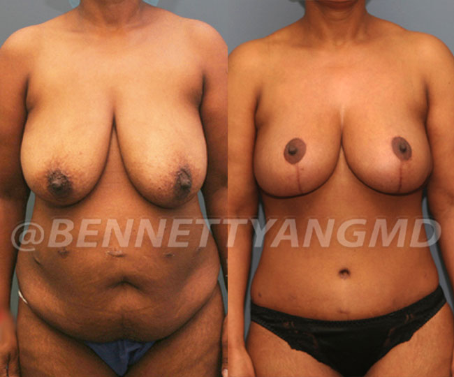 Breast Reduction Patient Before & After Images - Maryland Breast Surgeon