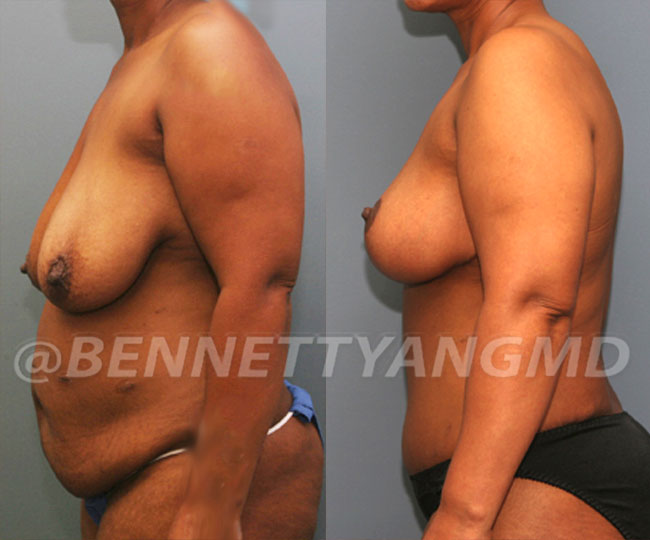 Breast Reduction Patient Before & After Images - Maryland Breast Surgeon