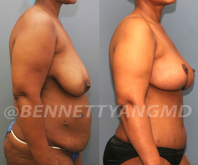 Breast Reduction Patient Before & After Images - Maryland Breast Surgeon