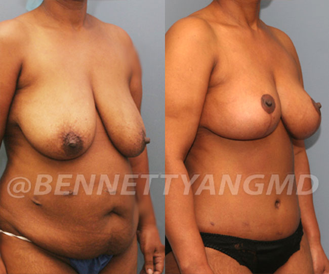 Breast Reduction Patient Before & After Images - Maryland Breast Surgeon