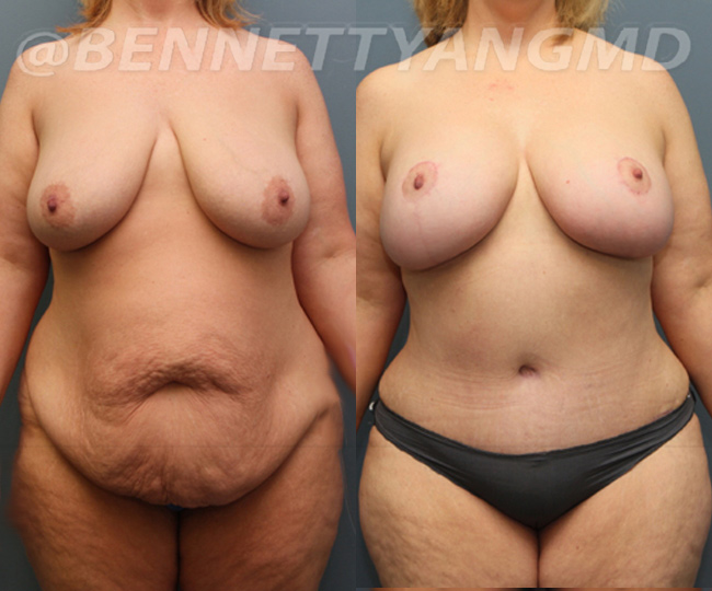 tummy tuck surgeon washington dc