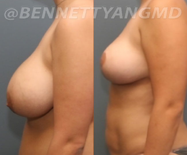 BBL Maryland Plastic Surgeon Bennett C. Yang