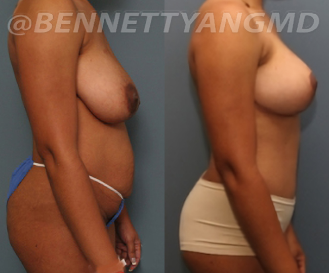 BBL Maryland Plastic Surgeon Bennett C. Yang