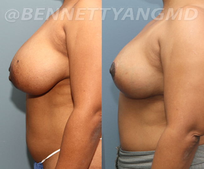 BBL Maryland Plastic Surgeon Bennett C. Yang