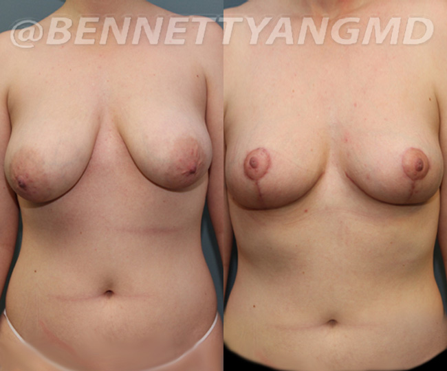 BBL Maryland Plastic Surgeon Bennett C. Yang