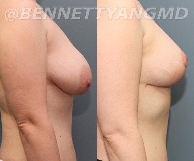 BBL Maryland Plastic Surgeon Bennett C. Yang