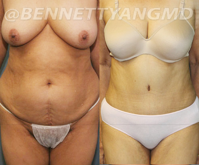 BBL Maryland Plastic Surgeon Bennett C. Yang