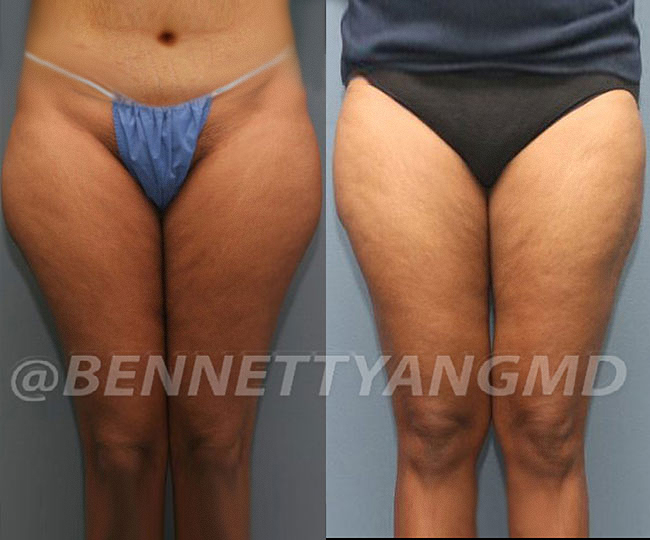 BBL Maryland Plastic Surgeon Bennett C. Yang