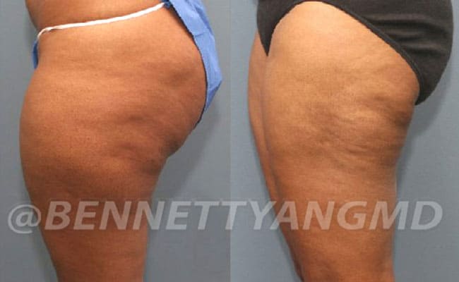 thigh-before_after-2a